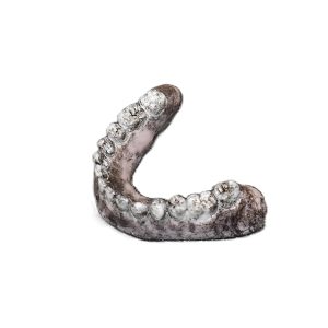 Lower Replacement Teeth (Burn Victim)