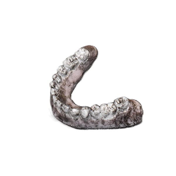 Lower Replacement Teeth (Burn Victim)