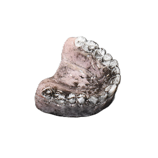 Upper Replacement Teeth (Burn Victim)